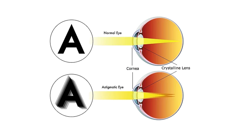 Astigmatismo