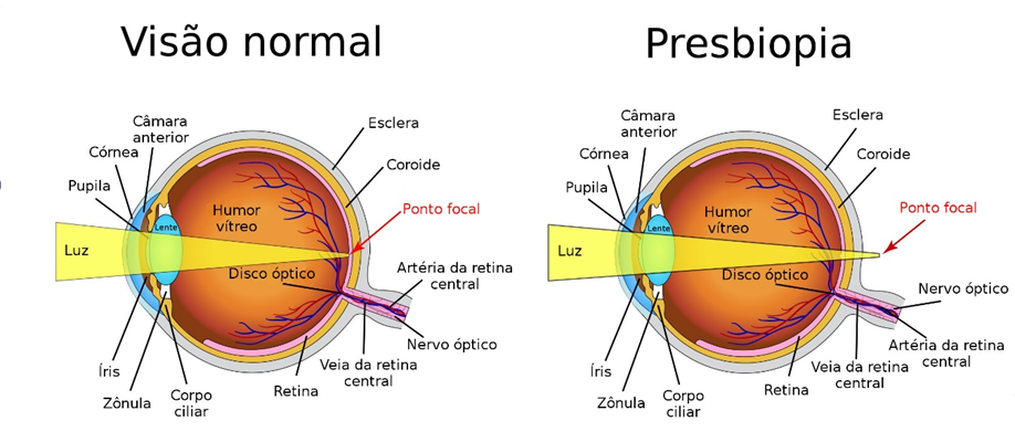 Presbiopia